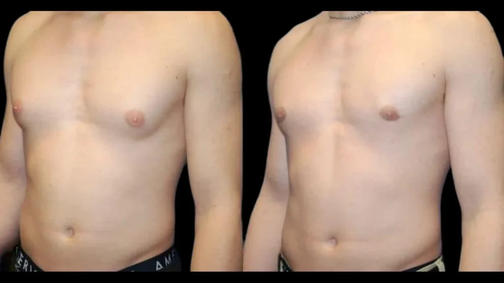 美容整形によるパフィー ニップルの修正 